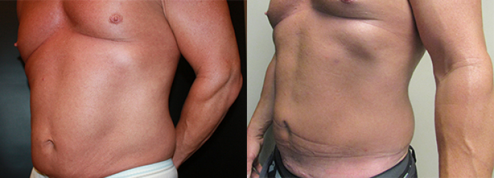 Male Tummy Tuck Before & After Pictures in Phoenix, AZ | The Body Sculpting  Center