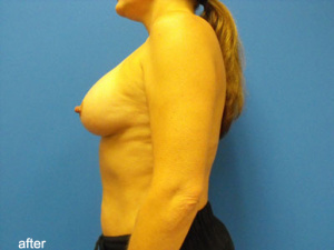 Fat Transfer to Breast Before and After Pictures Phoenix, AZ