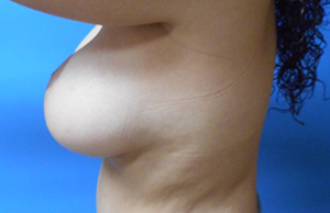 Tummy Tuck Before & After Pictures In Phoenix, AZ