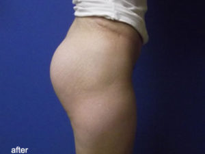 Buttock Augmentation Before and After Pictures in Phoenix, AZ
