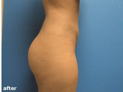 Buttock Augmentation Before and After Pictures in Phoenix, AZ