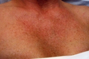 Chemical Peels Before & After Pictures in Phoenix, AZ