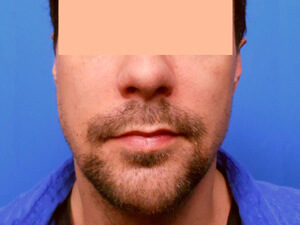 Chin Implants Before & After Pictures in Phoenix, AZ