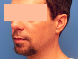 Chin Implants Before & After Pictures in Phoenix, AZ