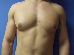 Gynecomastia Before & After Pictures in Phoenix, AZ