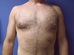 Gynecomastia Before & After Pictures in Phoenix, AZ