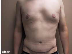 Male Tummy Tuck Before & After Pictures in Phoenix, AZ