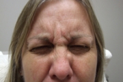 Botox® Before & After Pictures in Phoenix, AZ