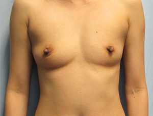 Breast Augmentation Before & After Pictures in Phoenix, AZ