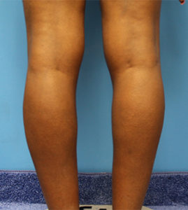 Calf Implants Before & After Pictures in Phoenix, AZ