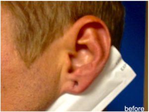 Ear Lobe Repair Before & After Pictures in Phoenix, AZ