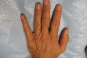 Hand Rejuvenation Before and After Pictures in Phoenix, AZ