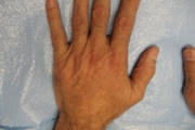Hand Rejuvenation Before and After Pictures in Phoenix, AZ