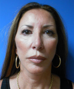 Lower Facelift Before & After Pictures In Phoenix, AZ