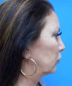 Lower Facelift Before & After Pictures In Phoenix, AZ