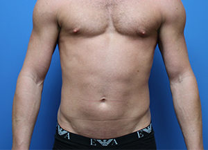Pectoral Implants Before & After Pictures in Phoenix, AZ
