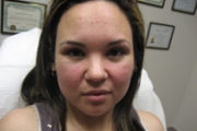 Photofacial Before & After Pictures in Phoenix, AZ
