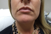 Restylane® Before and After Pictures in Phoenix, AZ