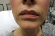 Restylane® Before and After Pictures in Phoenix, AZ