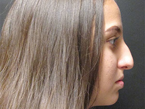 Rhinoplasty Before And After Pictures In Phoenix, AZ