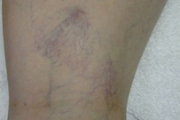 Sclerotherapy Before and After Pictures in Phoenix, AZ