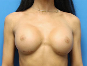 Breast Augmentation Before & After Pictures in Phoenix, AZ