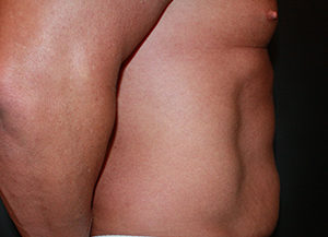 Male Tummy Tuck Before & After Pictures in Phoenix, AZ