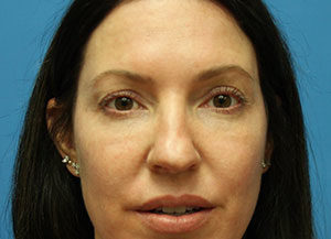Eyelid Surgery (Blepharoplasty) Before & After Pictures in Phoenix, AZ