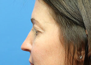 Eyelid Surgery (Blepharoplasty) Before & After Pictures in Phoenix, AZ