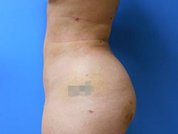 Fat Transfer Before & After Pictures in Phoenix, AZ