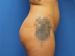 Fat Transfer Before & After Pictures in Phoenix, AZ