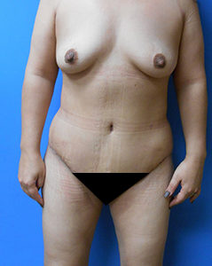 Liposuction Before & After Pictures in Phoenix, AZ