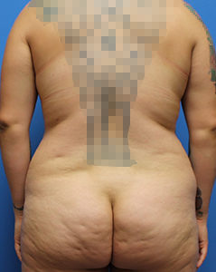 Liposuction Before & After Pictures in Phoenix, AZ