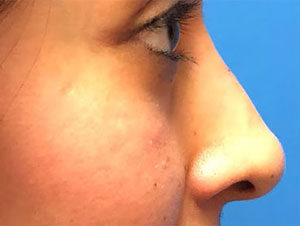 Rhinoplasty Before And After Pictures In Phoenix, AZ