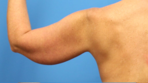Arm Lift Before & After Pictures in Phoenix, AZ