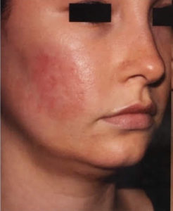 Microneedling Before and After Pictures in Phoenix, AZ