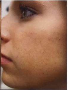 Microneedling Before and After Pictures in Phoenix, AZ
