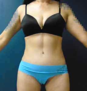 Tummy Tuck Before & After Pictures in Phoenix, AZ