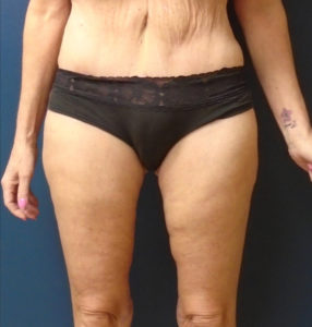 Thigh lift Before and After Pictures Phoenix, AZ