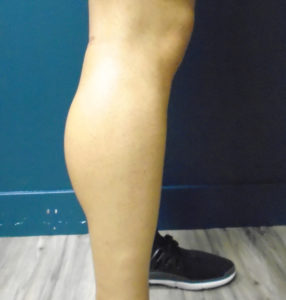 Calf Implants Before and After Pictures Phoenix, AZ