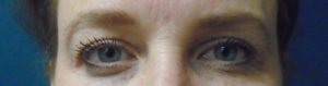 Eyelid Surgery (Blepharoplasty) Before and After Pictures Phoenix, AZ