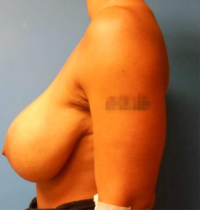 Breast Augmentation Before and After Pictures Phoenix, AZ