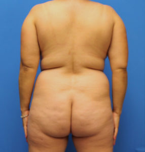 Fat Transfer Before and After Pictures Phoenix, AZ