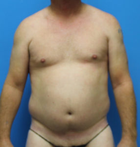 Pectoral Implants Before and After Pictures Phoenix, AZ