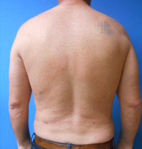 Pectoral Implants Before and After Pictures Phoenix, AZ