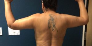 Arm Lift Before & After Pictures in Phoenix, AZ