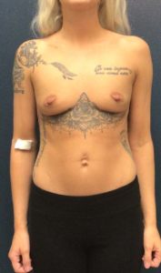 BREAST AUGMENTATION BEFORE & AFTER PICTURES IN PHOENIX, AZ