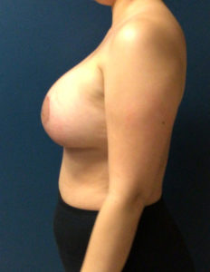 BREAST LIFT BEFORE & AFTER PICTURES IN PHOENIX, AZ
