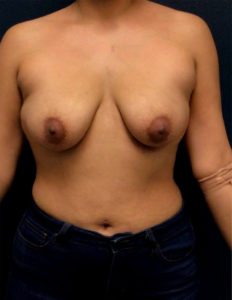 BREAST LIFT BEFORE & AFTER PICTURES IN PHOENIX, AZ