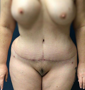 Liposuction Before and After Pictures Phoenix, AZ